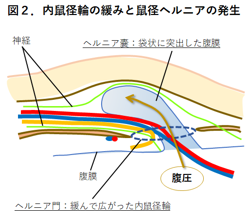 【図２】内鼠径輪の緩みと鼠径ヘルニアの発生2.png