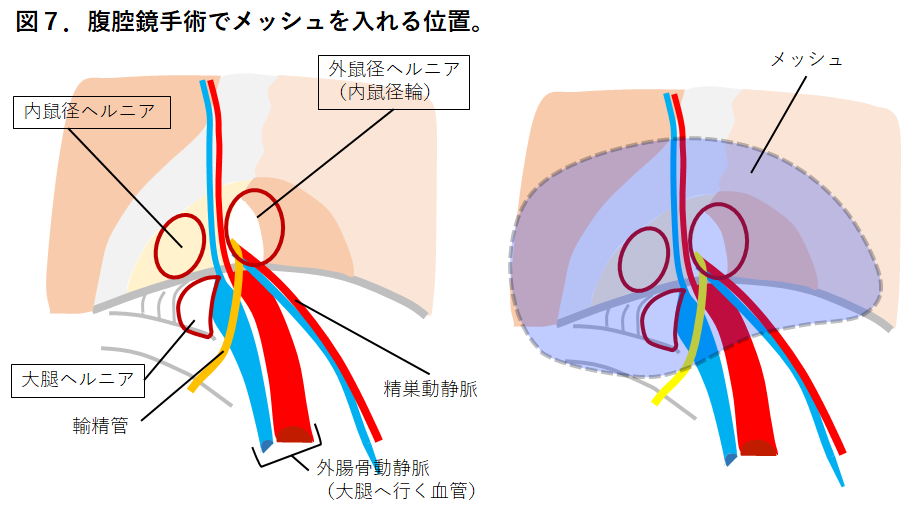 【図７】腹腔鏡手術でメッシュを入れる位置2.png
