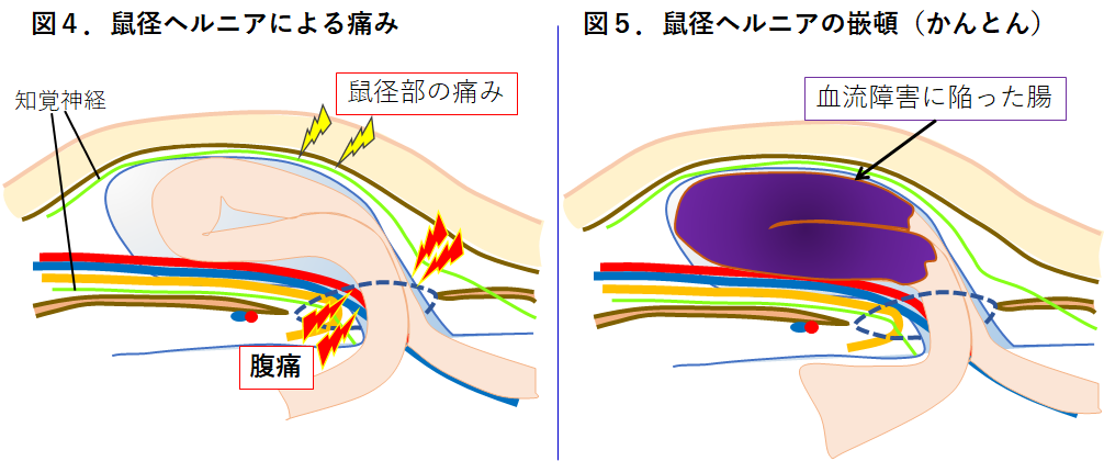 【図４】鼠径ヘルニアによる痛み【図５】かんとん.png