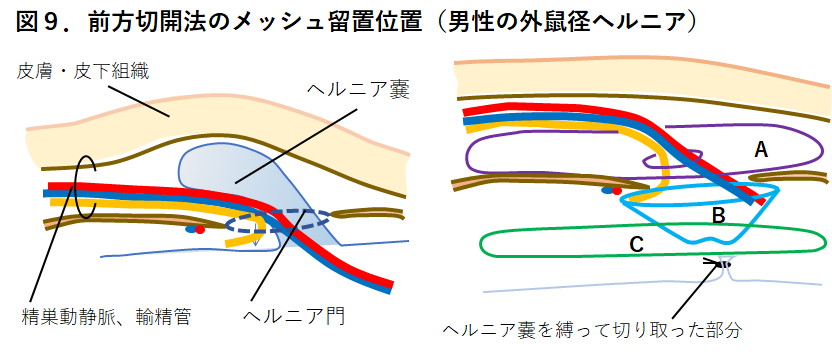 【図９】前方切開法のメッシュ留置位置2.png