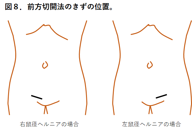 【図８】前方切開法のきずの位置2.png