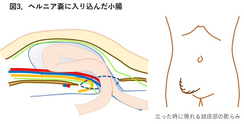 【図３】ヘルニア嚢に入り込んだ小腸2.png
