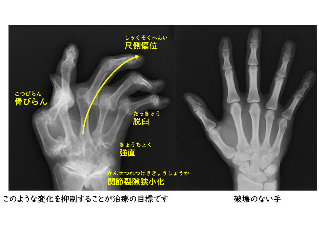 手のレントゲン画像でみるリウマチの骨･関節破壊、関節裂隙狭小化、骨びらん、脱臼、尺側偏移など